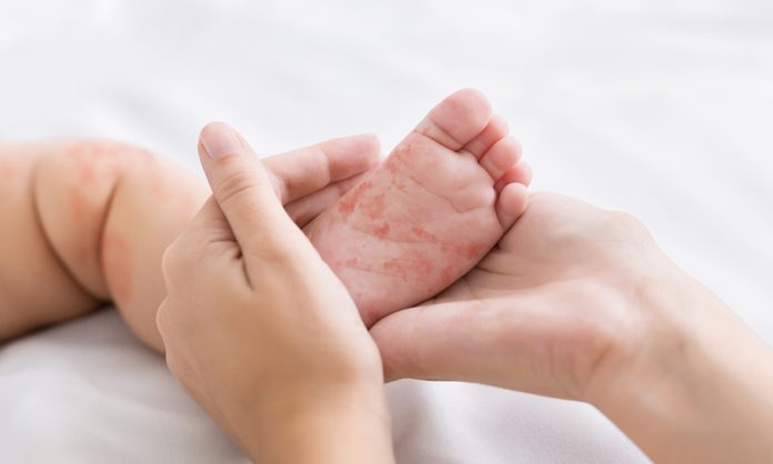 Baby with Measles on Feet